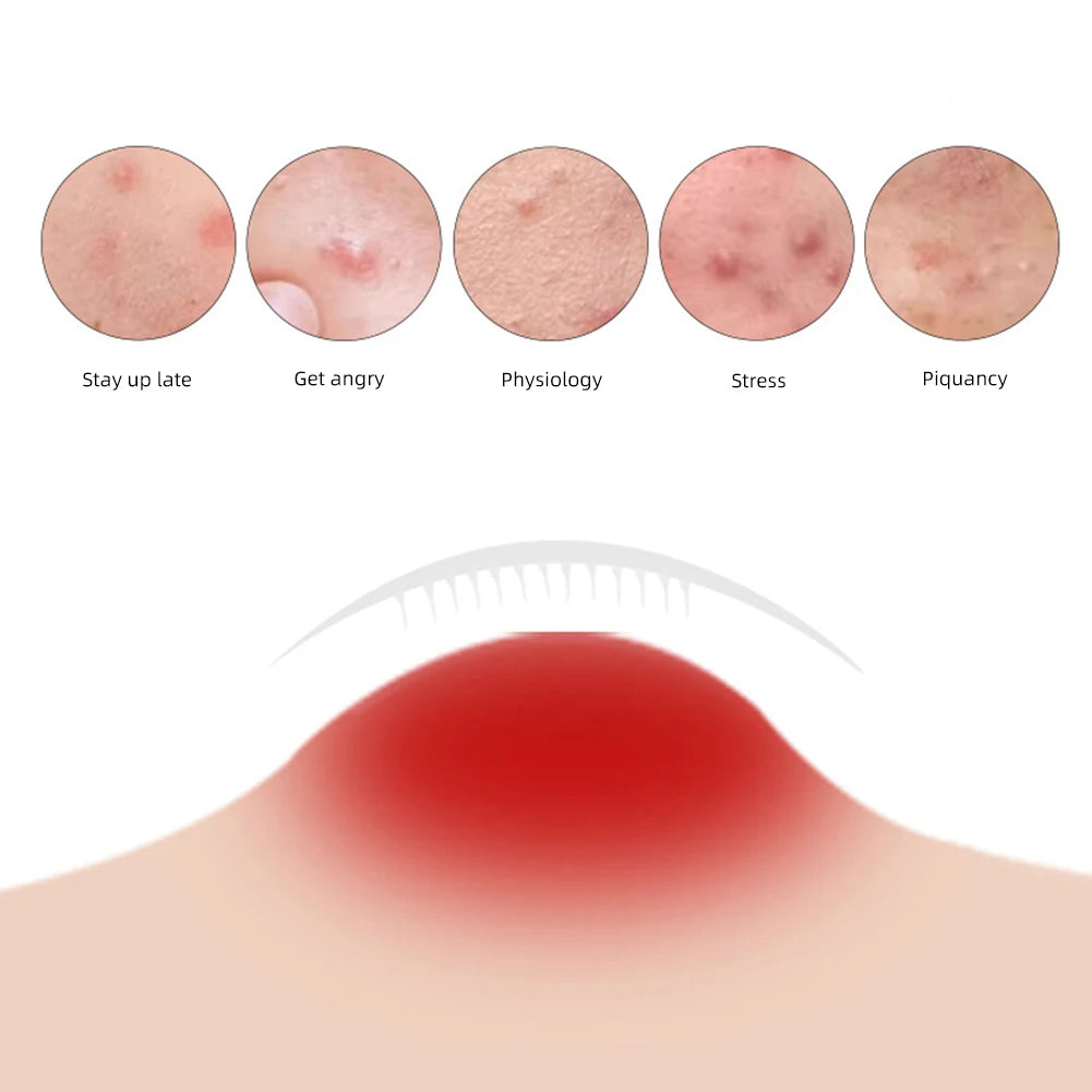 9Pcs Soluble Microneedle Hydrocolloid Acne Patch Invisible Breathable Acne Patch Available Day And Night Skin Care Repair Patch